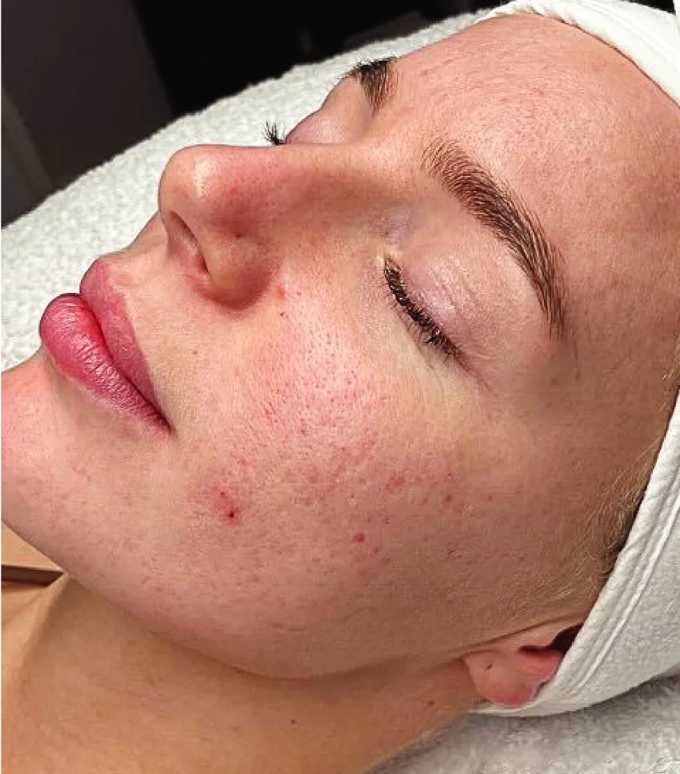 Tiêm trẻ hóa tái tạo da Exosome