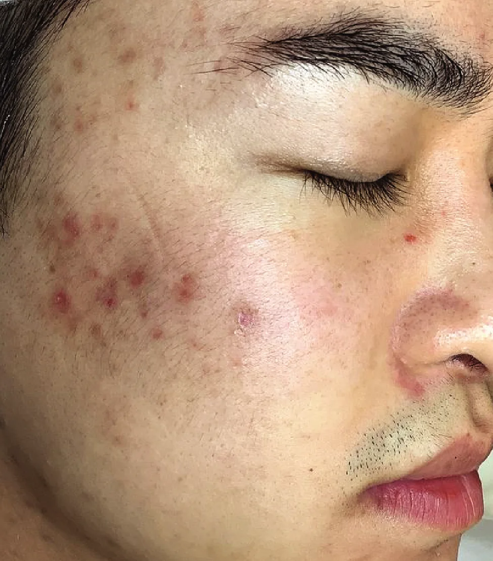 Tiêm trẻ hóa tái tạo da Exosome