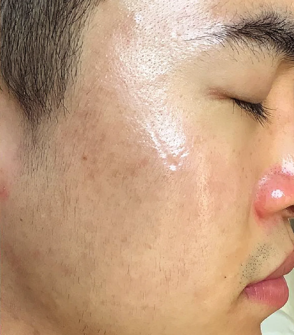 Tiêm trẻ hóa tái tạo da Exosome