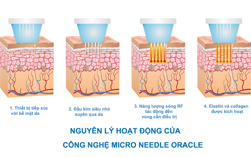 Se khít lỗ chân lông và trị sẹo Micro Needle Oracle