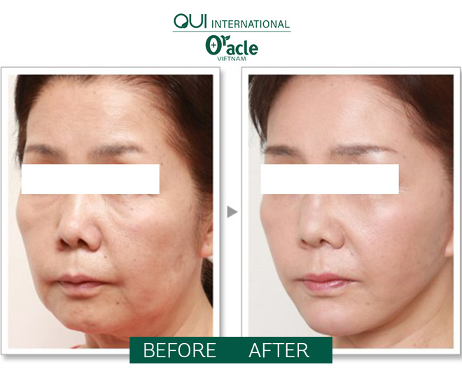 Trẻ đẹp tức thì với căng chỉ collagen tại Oracle - 5