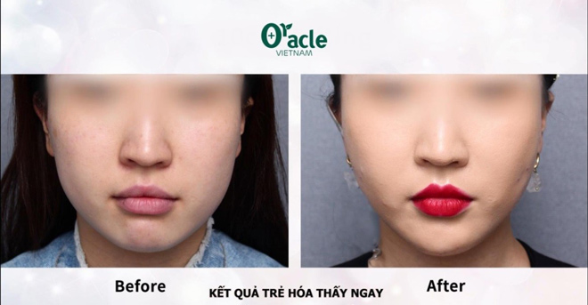 Trẻ đẹp tức thì với căng chỉ collagen tại Oracle - 2