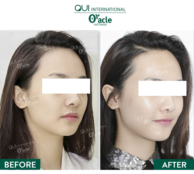 Bio-Whitening – “vắc-xin” phòng ngừa lão hóa sớm cho da - 4