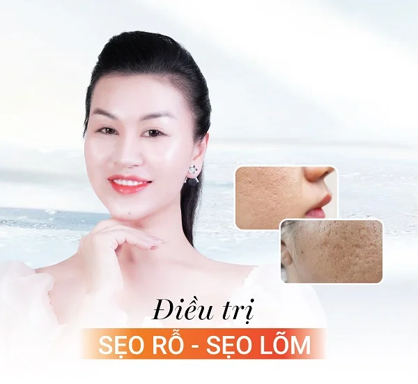 Sẹo rỗ, sẹo lõm