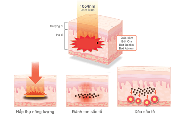 Điều trị bớt Ota