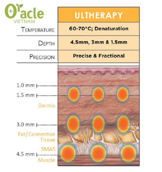 Xóa nếp nhăn bằng Ultherapy