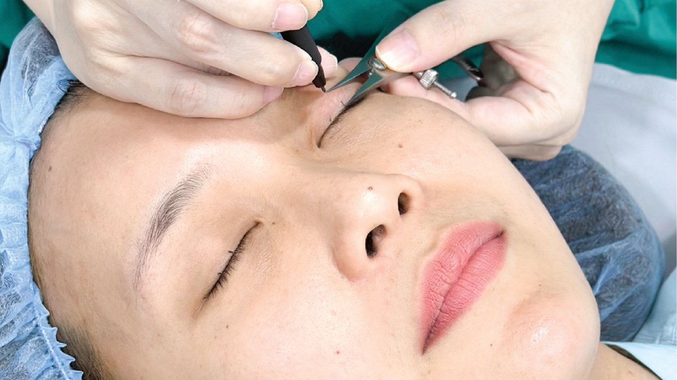 Bác sĩ thực hiện đo vẽ vùng mí dưới trước khi phẫu thuật