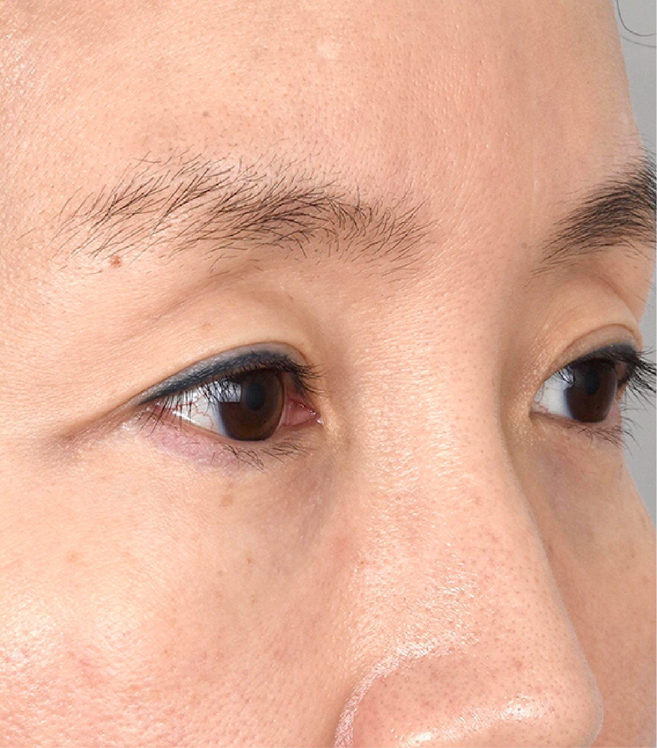 Hinh-anh-truoc-khi-thuc-hien-lay-mo-mi-mat-cua-khach-hang