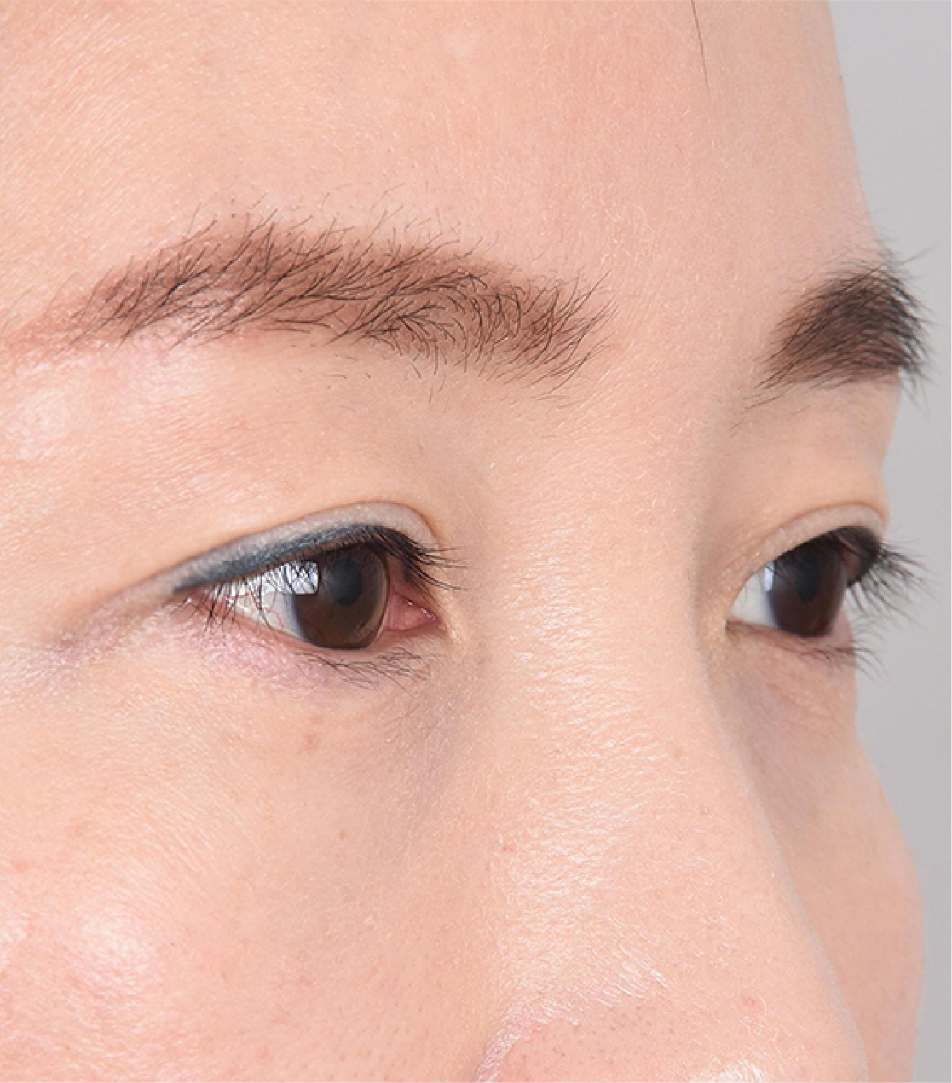 Hinh-anh-sau-khi-thuc-hien-lay-mo-mi-mat-cua-khach-hang