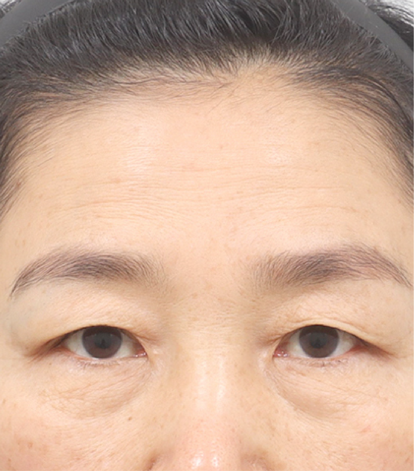 Hình ảnh trước khi xóa rãnh lệ 1