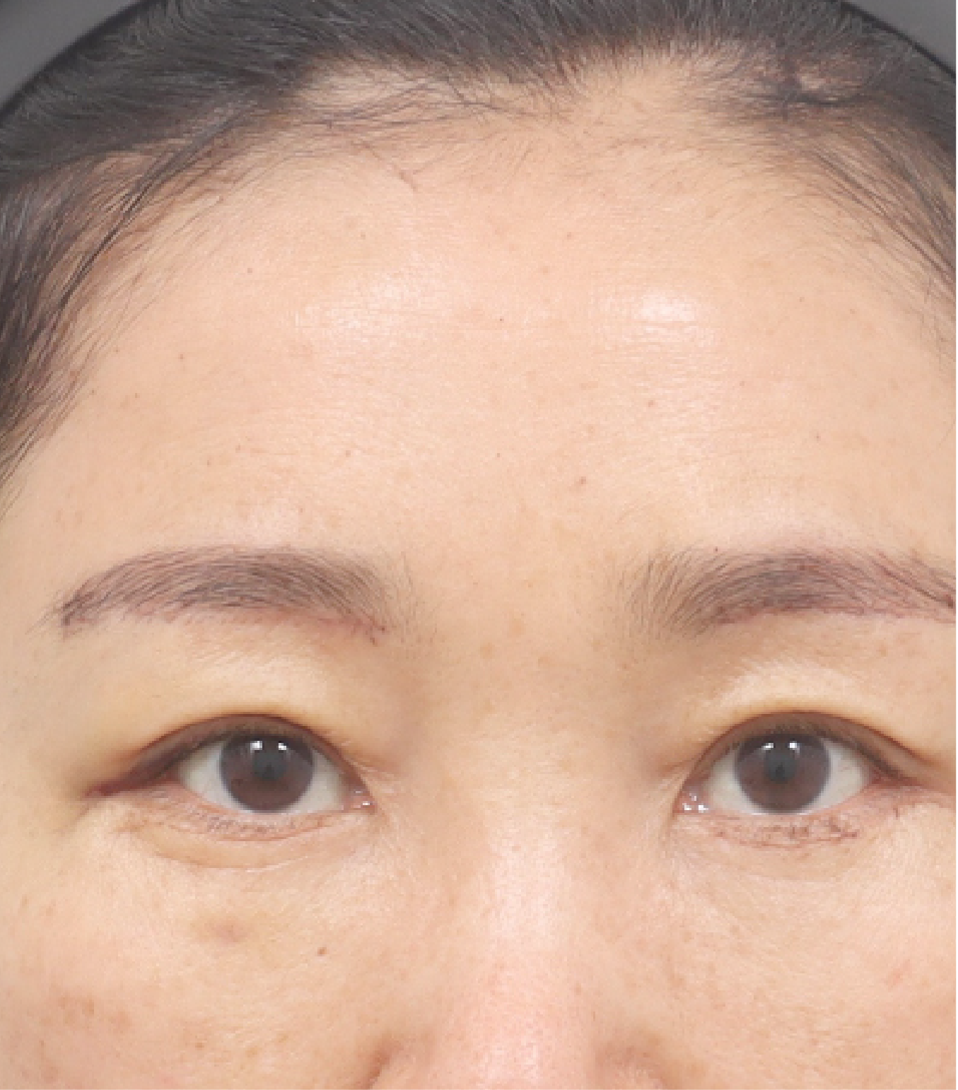 Hình ảnh sau khi xóa rãnh lệ 1