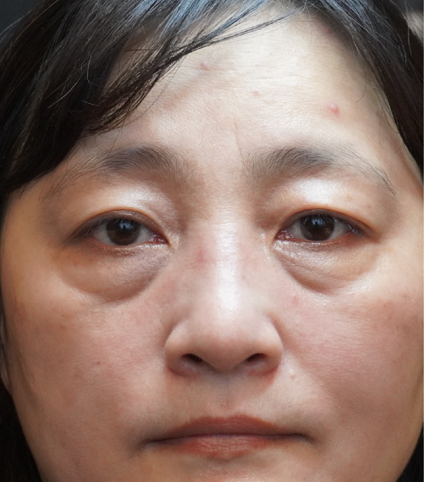 Hình ảnh trước khi xóa rãnh lệ 2