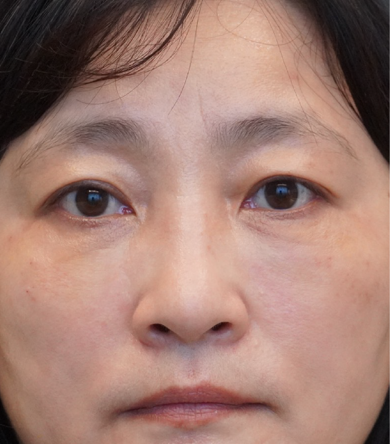 Hình ảnh sau khi xóa rãnh lệ 2