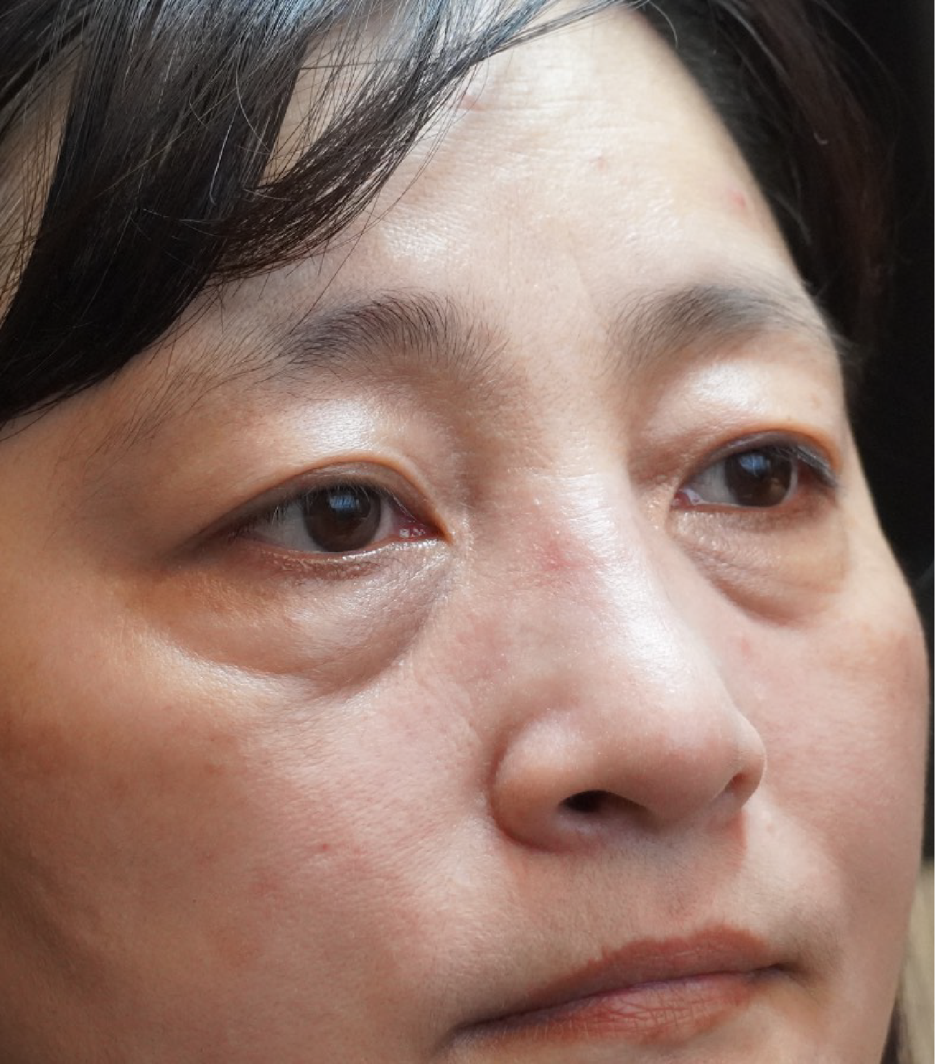 Hình ảnh trước khi xóa rãnh lệ 3