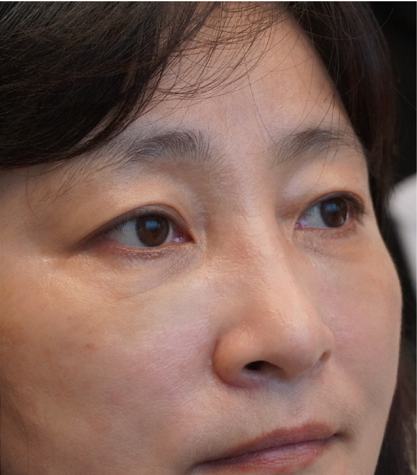 Hình ảnh sau khi xóa rãnh lệ 3