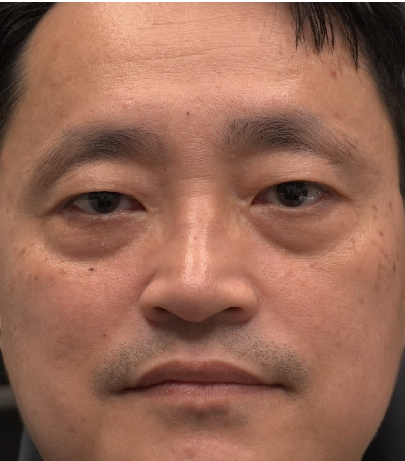 Hình ảnh trước khi xóa rãnh lệ 4