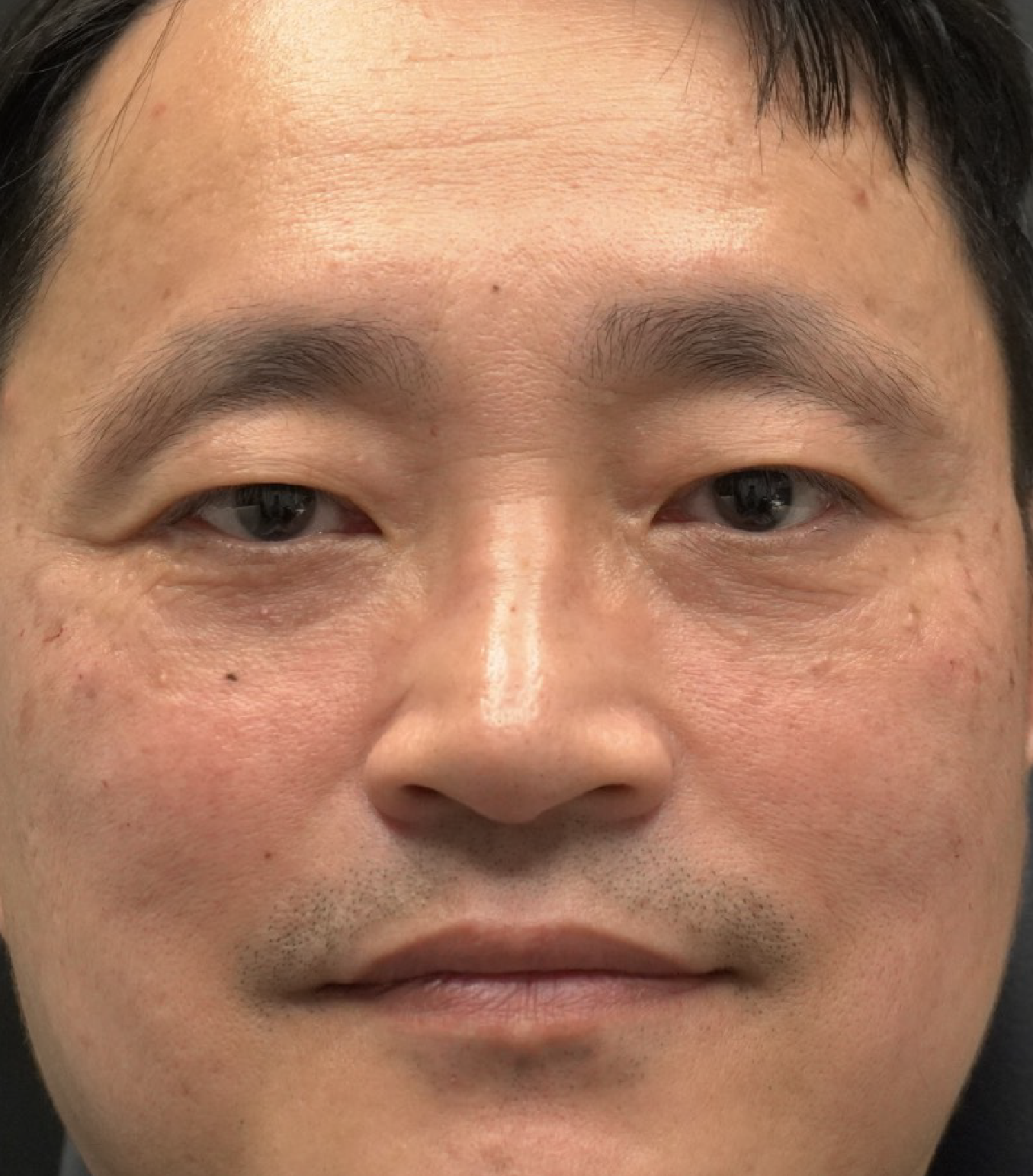 Hình ảnh sau khi xóa rãnh lệ 4