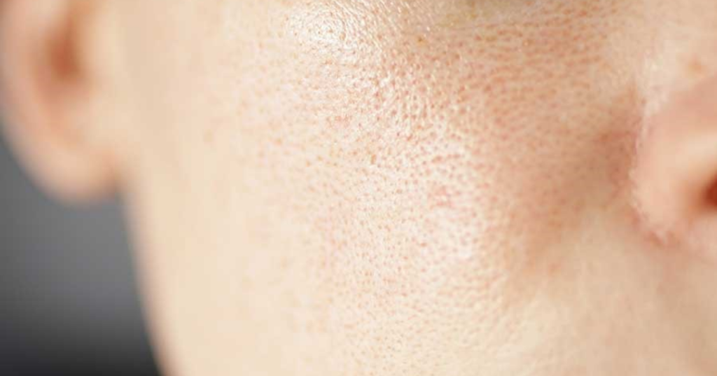 da chảy xệ lỗ chân lông