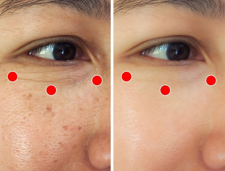 lao-hoa-da-sau-tuoi-30-3