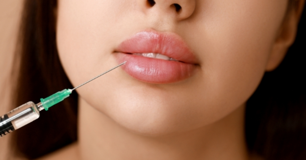 Tiêm filler bao lâu thì vào form bao lâu thì tan