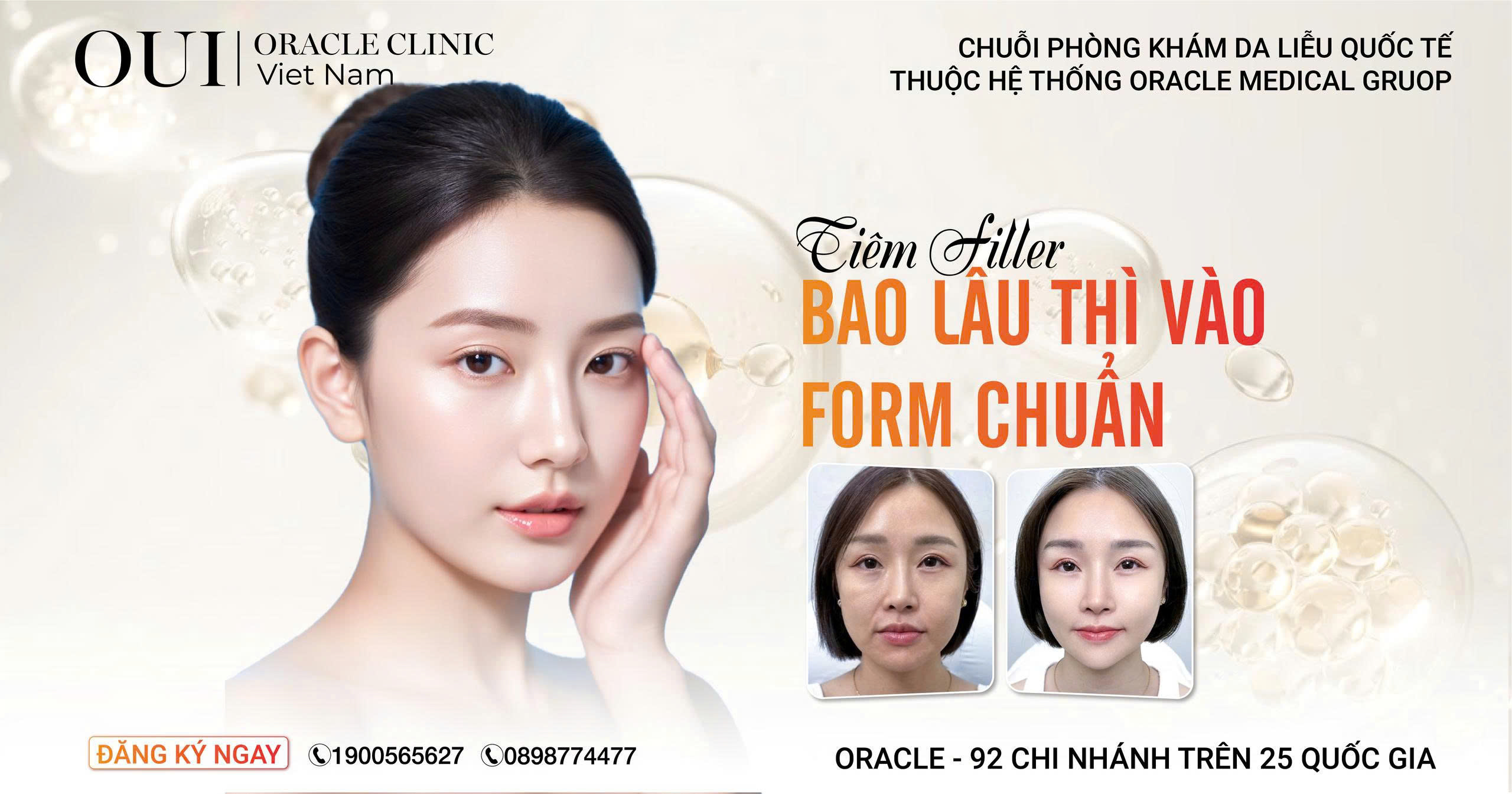 tiêm filler bao lâu thì vào form thumpnail