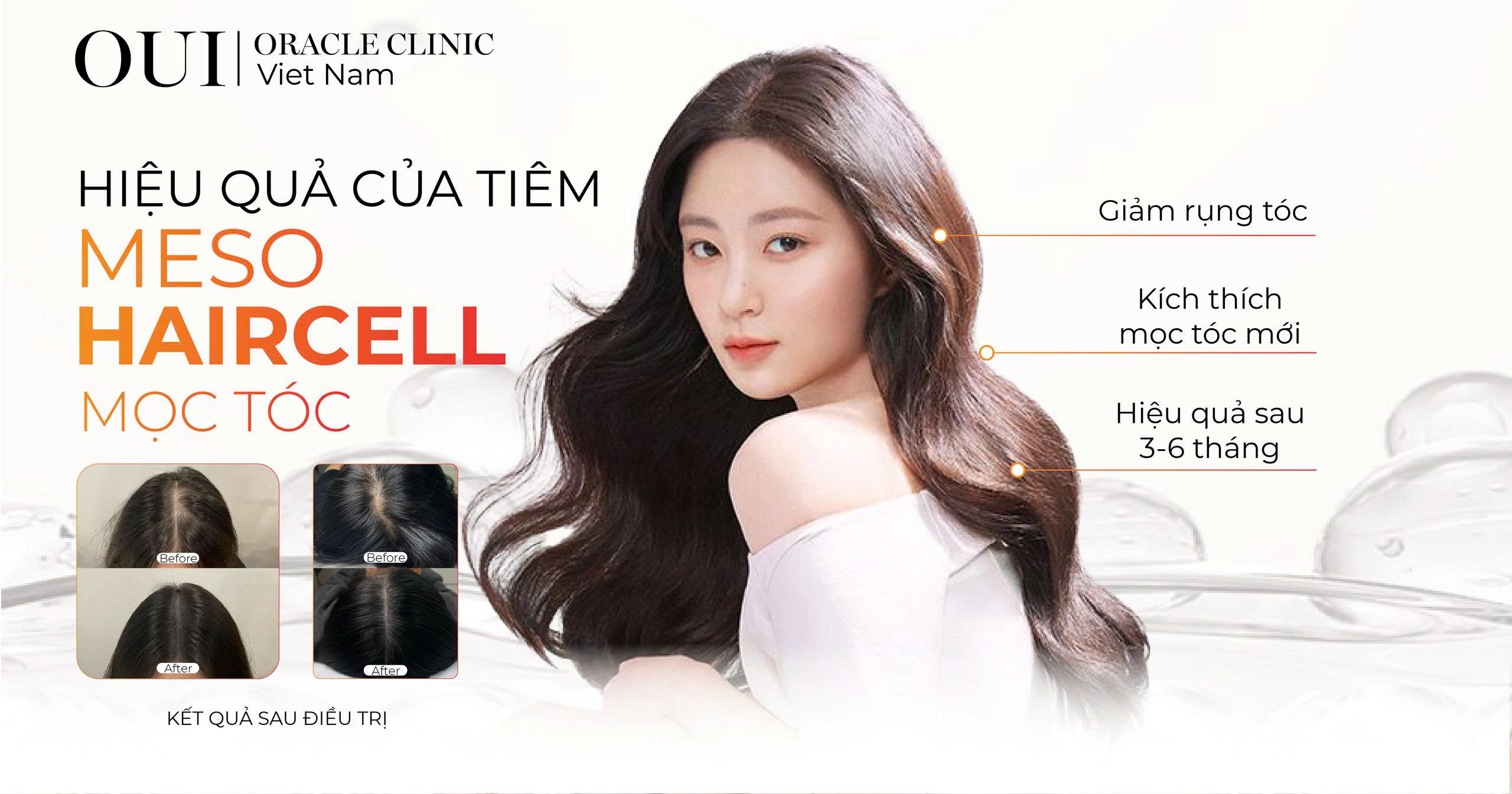 tiêm meso haircell