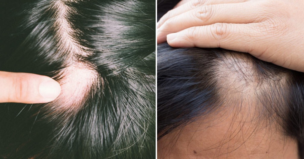 tiêm meso mọc tóc phương pháp trị rụng tóc