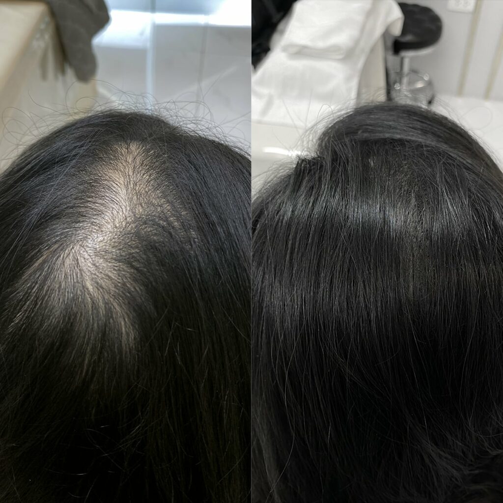 tiêm meso mọc tóc có hiệu quả không