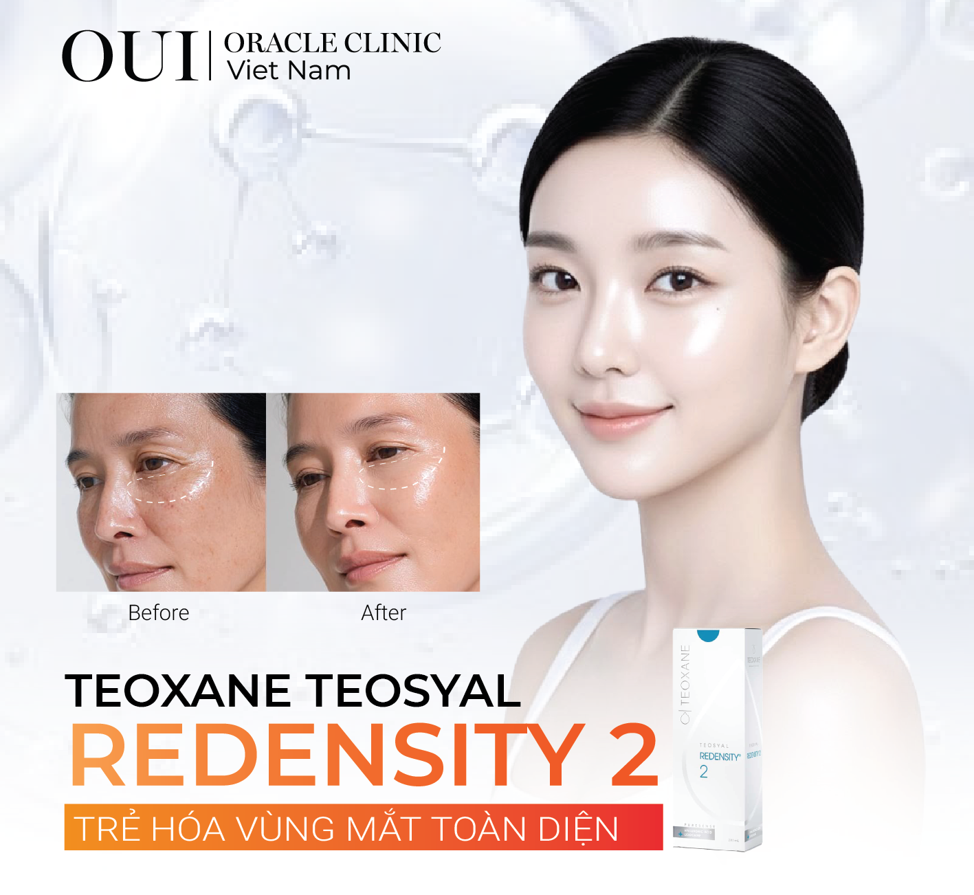 Tiêm giảm thâm mắt, săn chắc vùng mắt Redensity 2