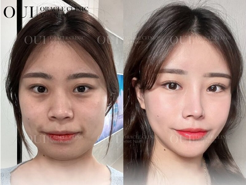 30 tuổi có nên trẻ hóa bằng thermage FLX