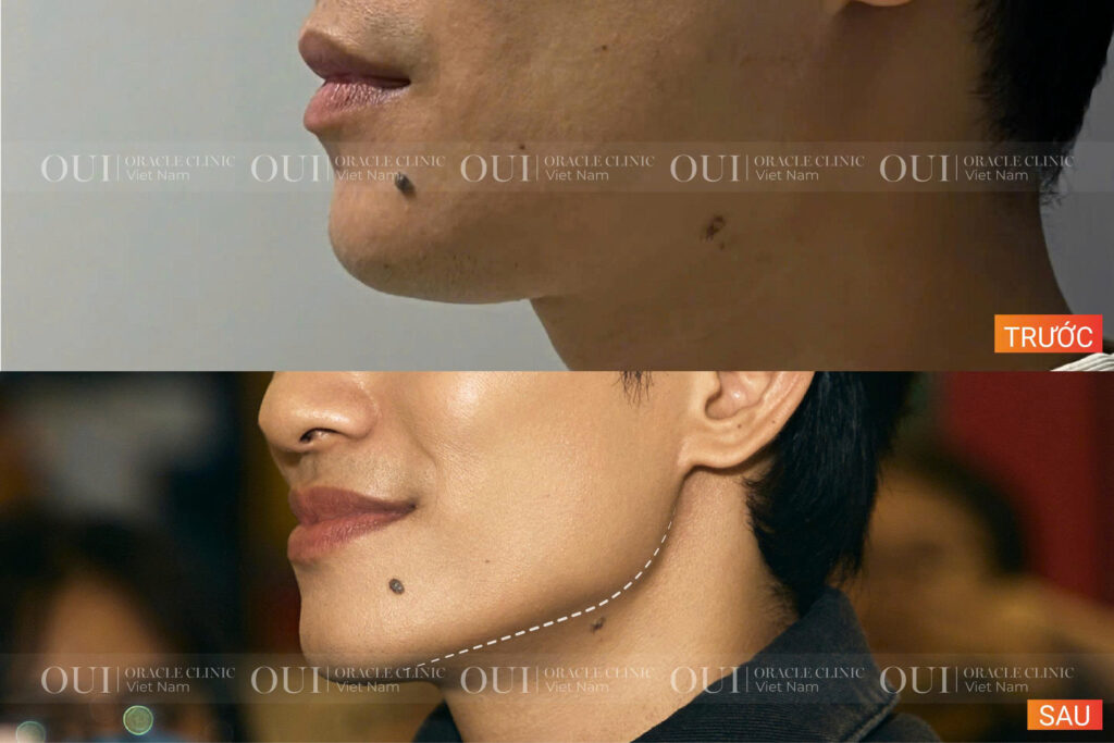 30 tuổi có nên trẻ hóa bằng Ultherapy