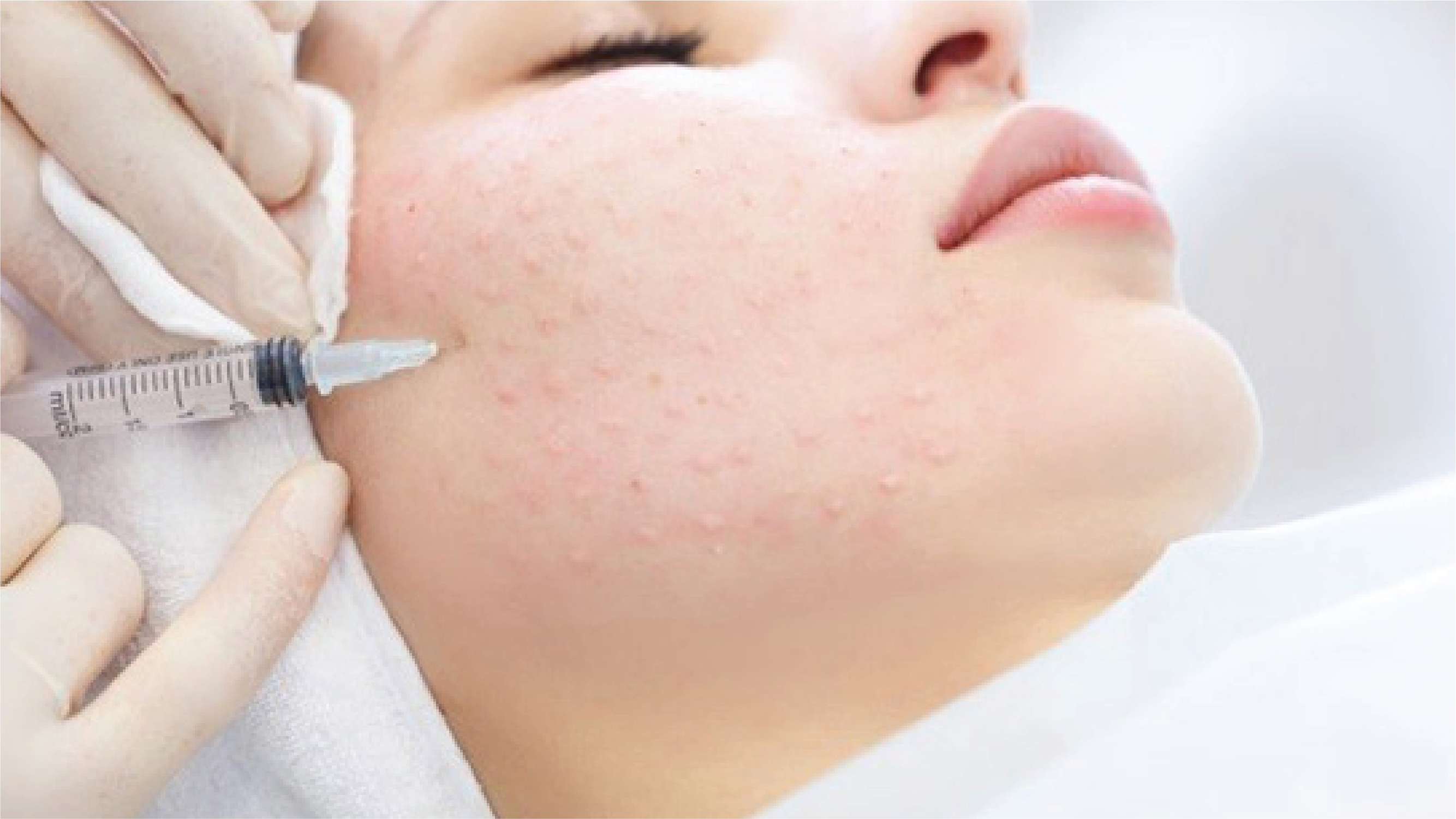 Tiêm meso đưa tinh chất Exocode vào da