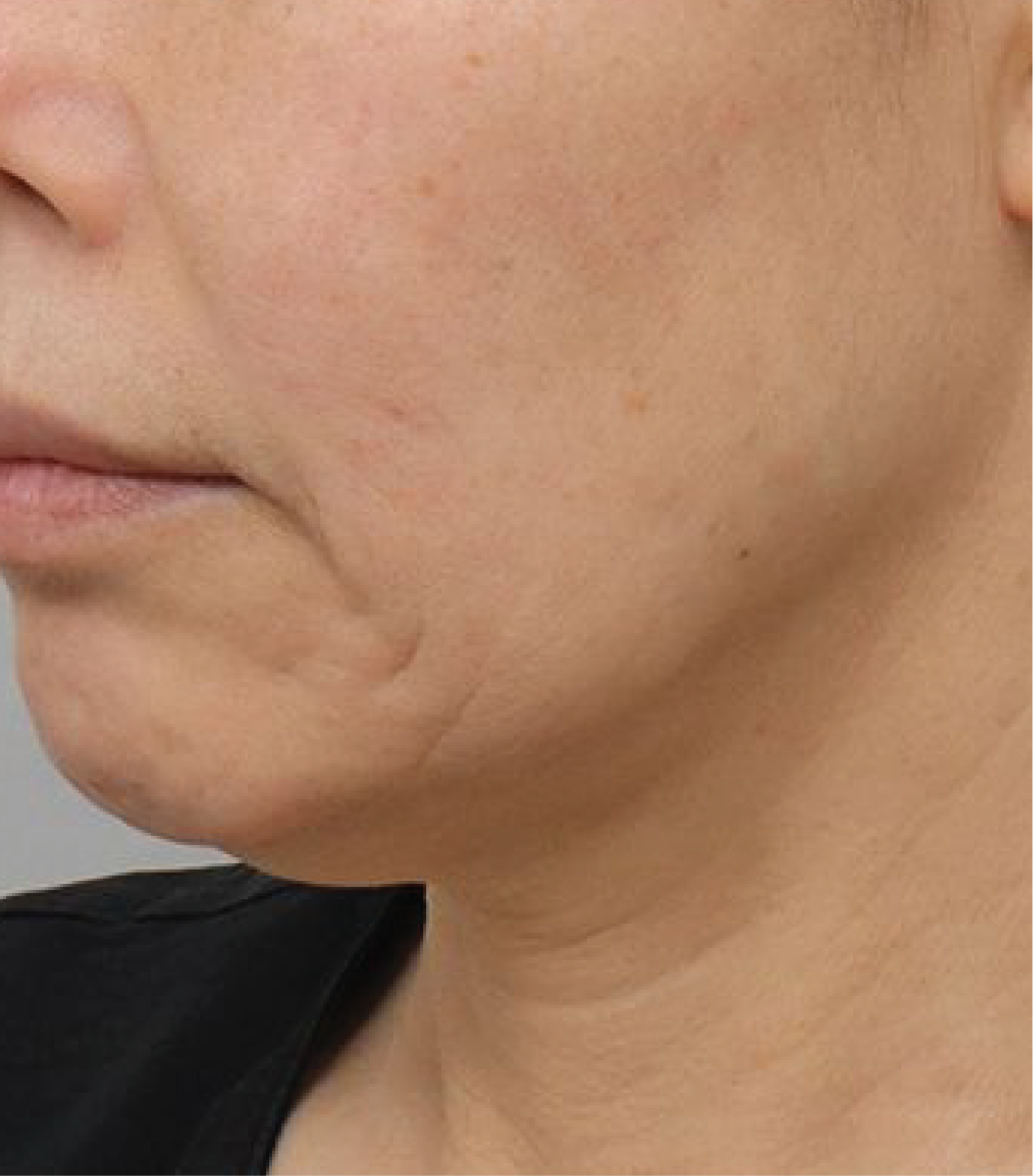 Hình ảnh trước khi tiêm BAP Karisma