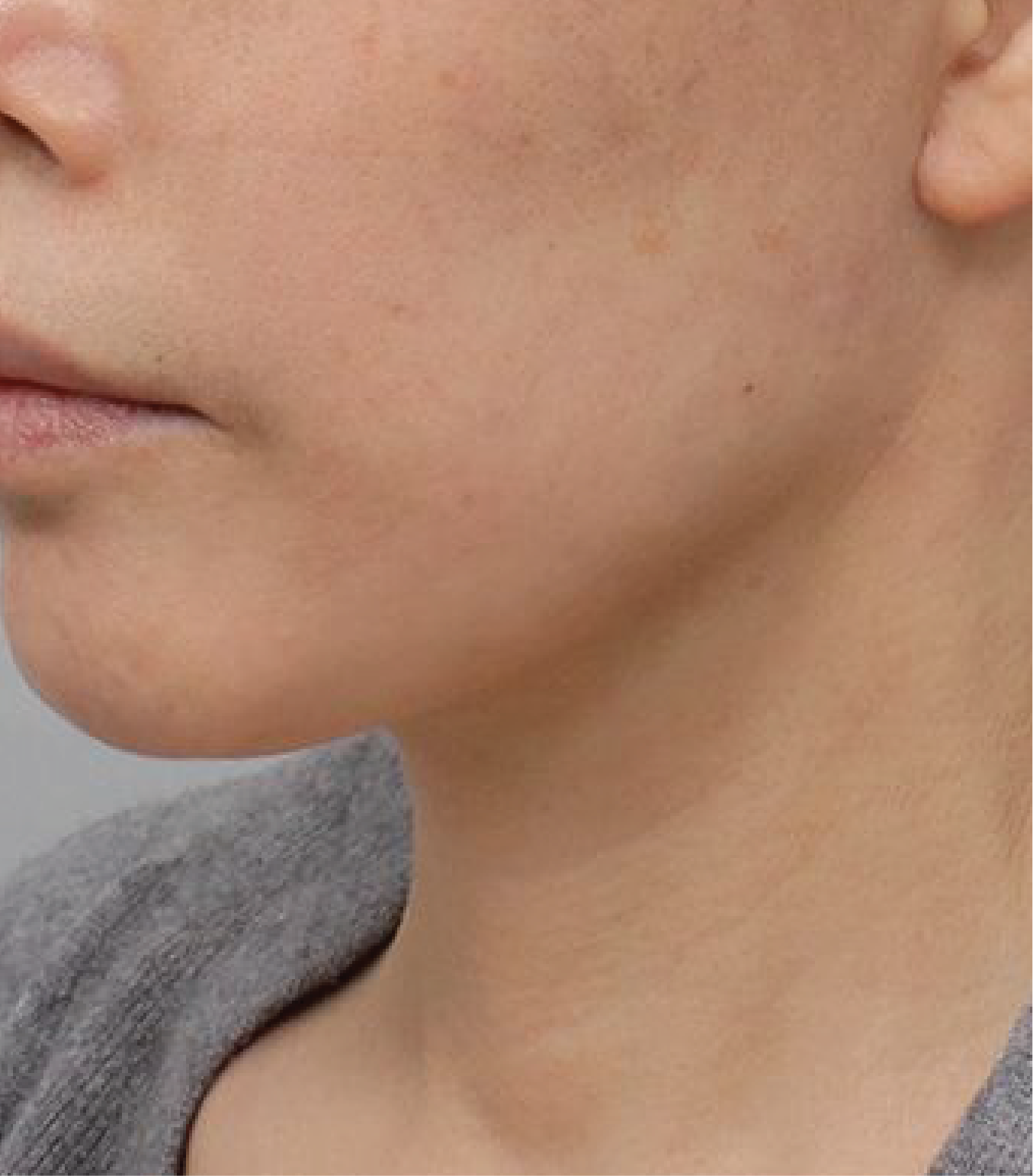 Hình ảnh sau khi tiêm BAP Karisma