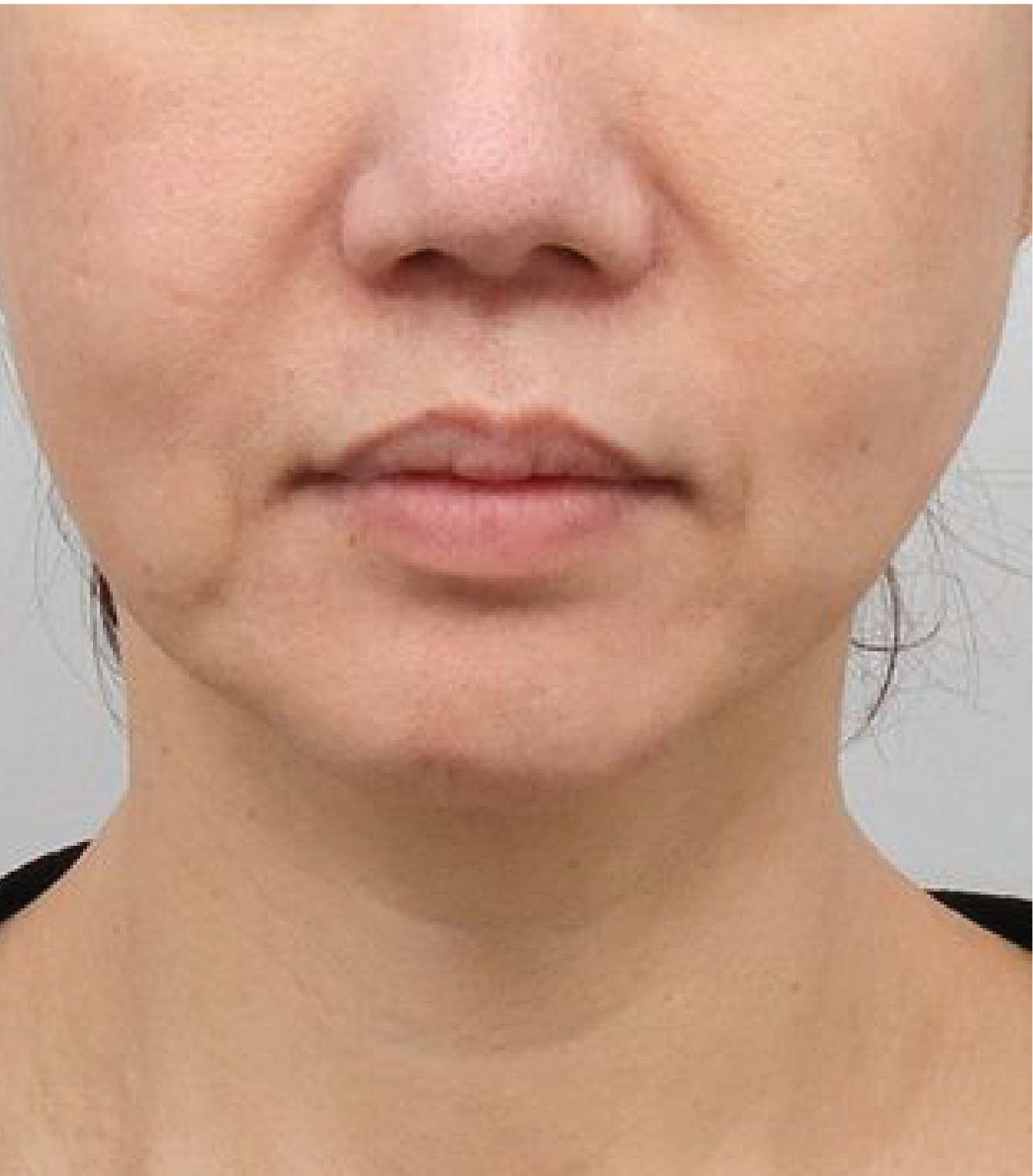 hình ảnh trước khi tiêm BAP Karisma