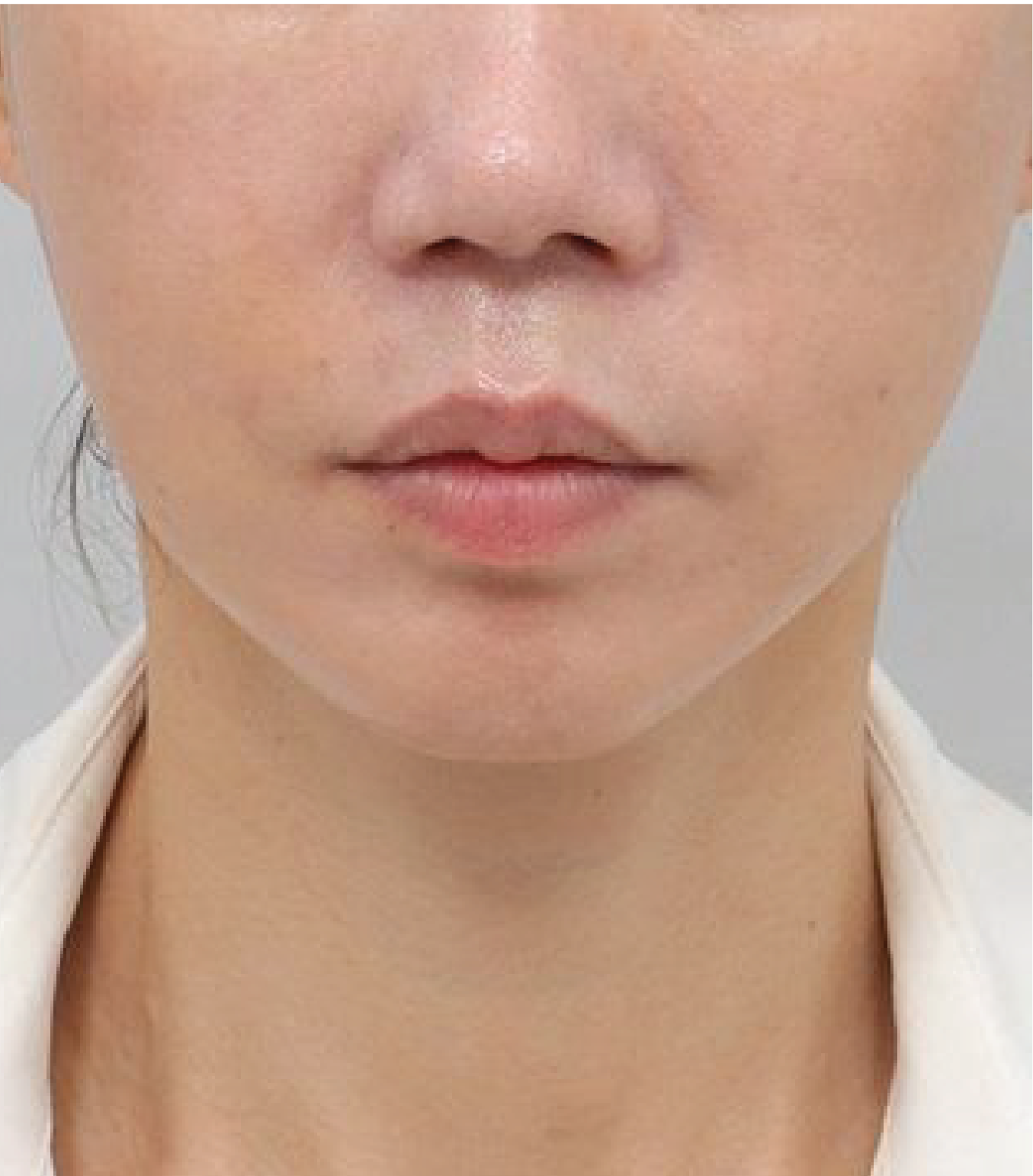 hình ảnh sau khi tiêm BAP Karisma