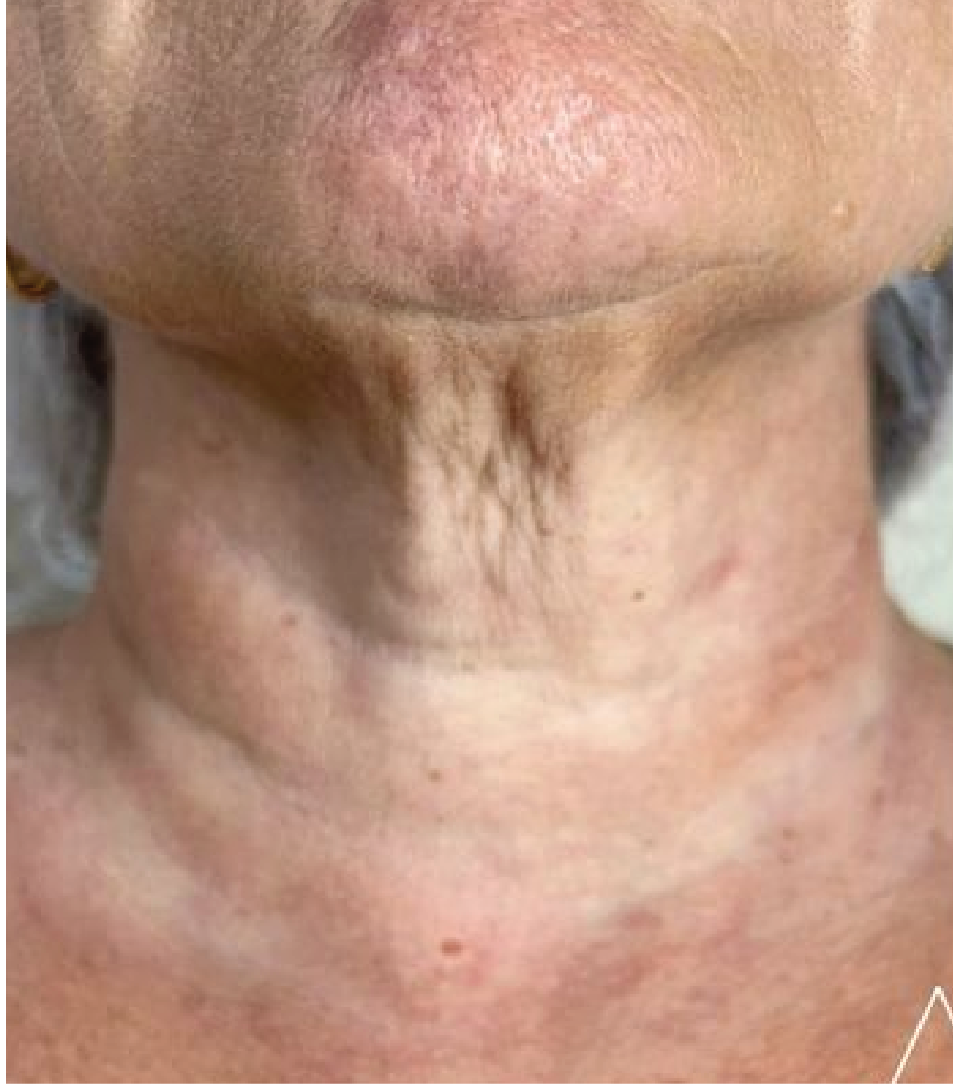 hình ảnh trước khi tiêm Karisma