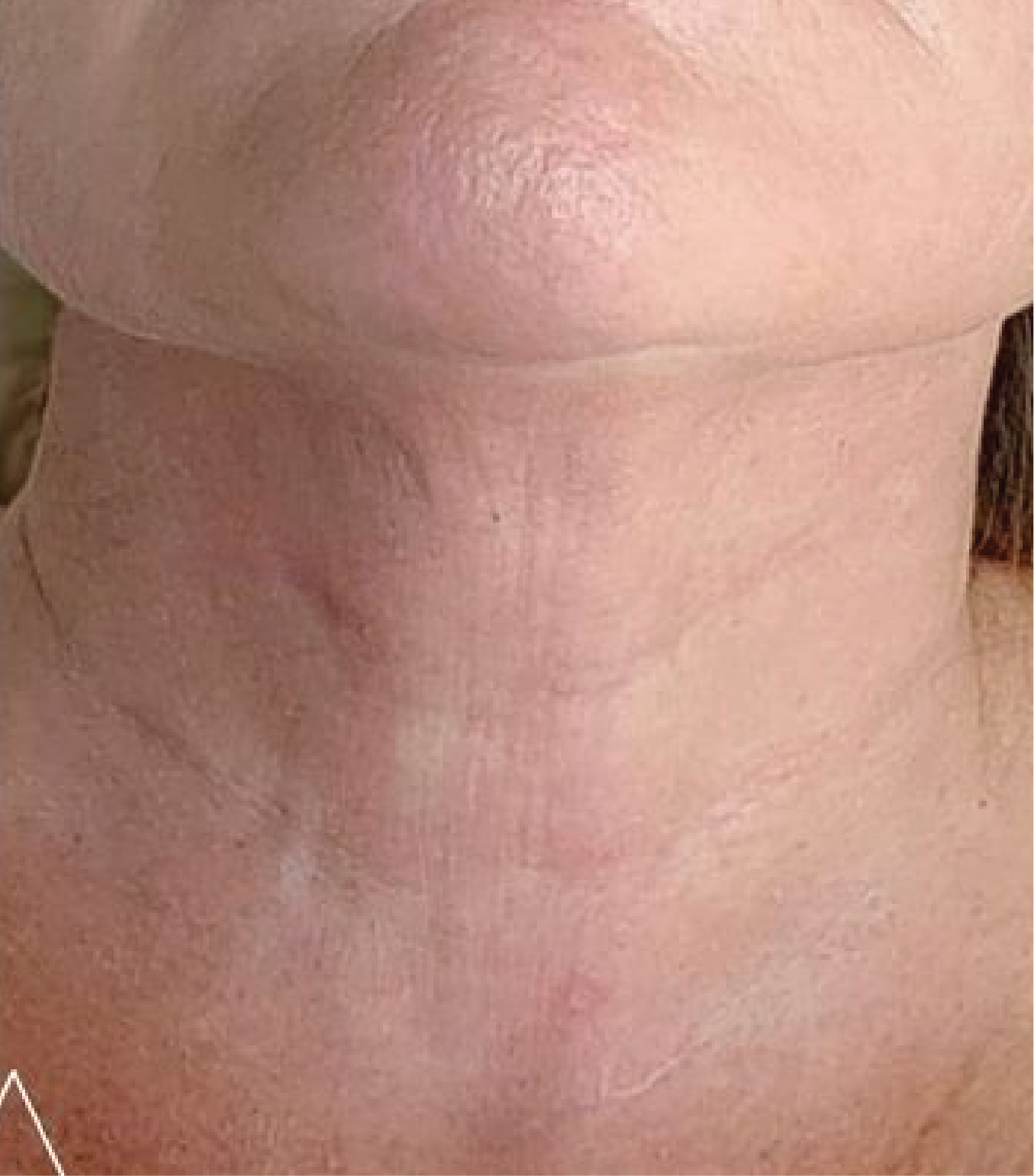 hình ảnh sau tiêm BAP Karisma