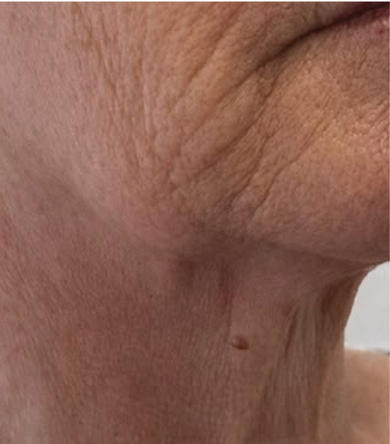 hình ảnh trước khi tiêm Karisma