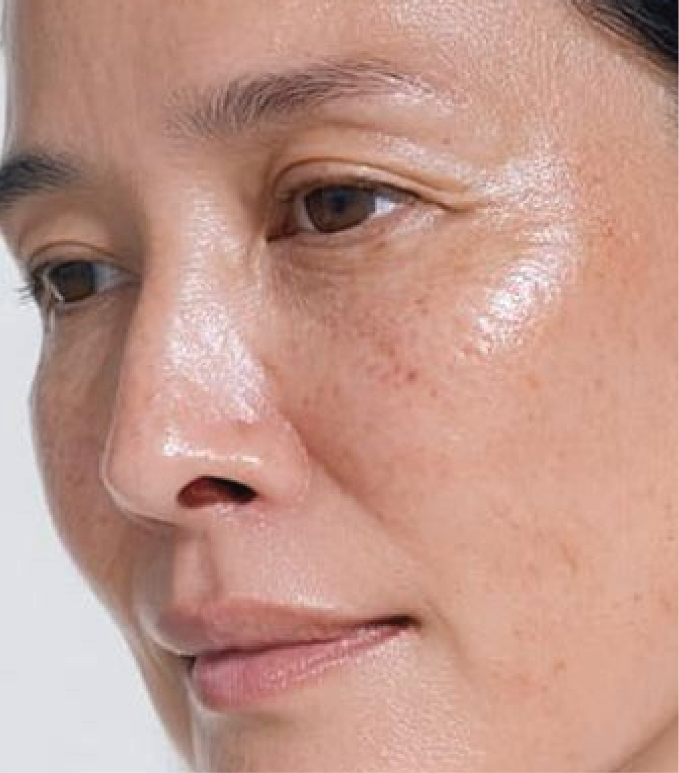 hình ảnh trước khi tiêm Karisma