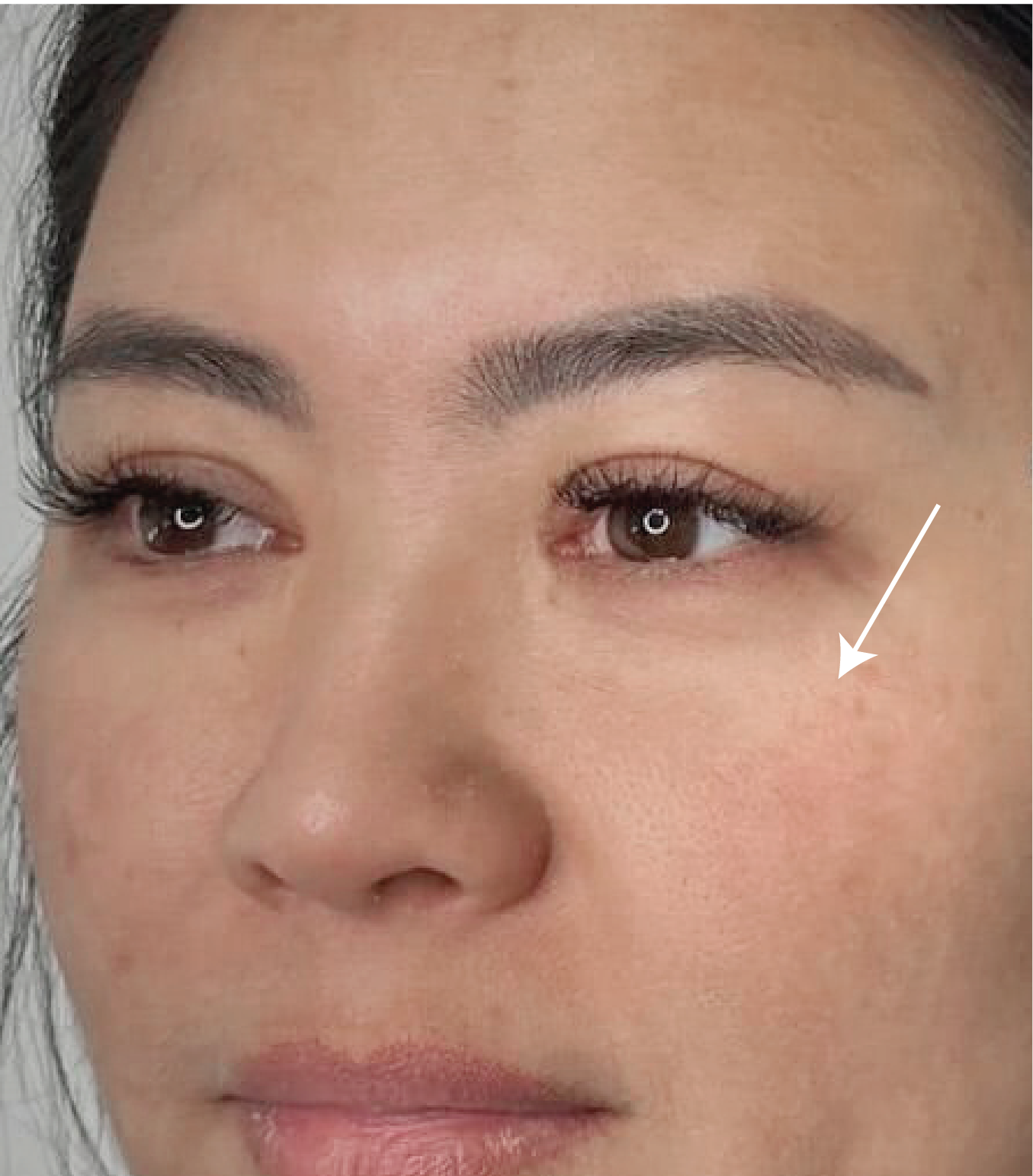 Hình ảnh trước và sau tiêm Meso Rejuran Eye