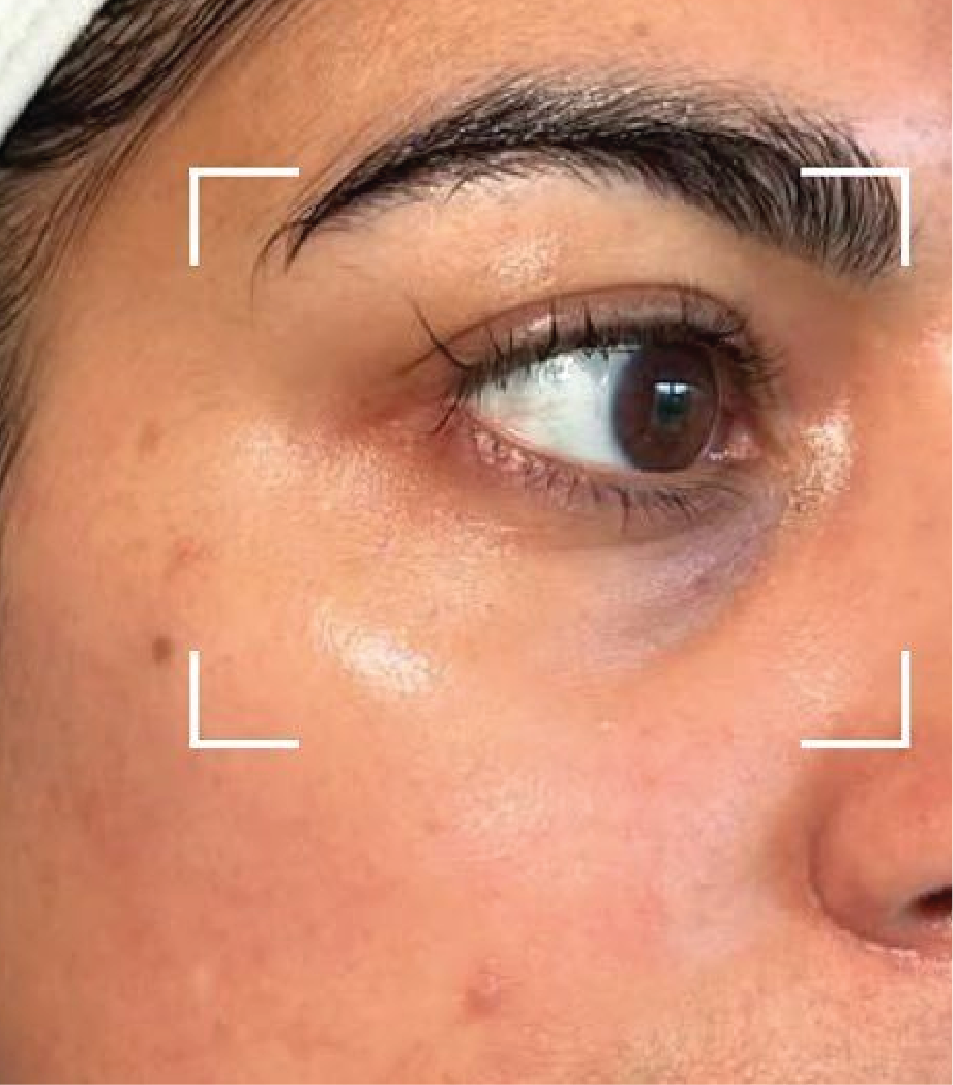 Hình ảnh trước và sau tiêm Meso Rejuran Eye