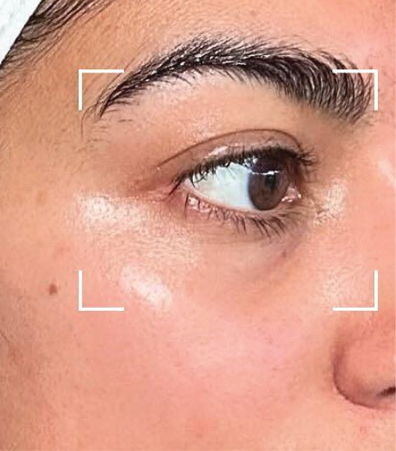 Hình ảnh trước và sau tiêm Meso Rejuran Eye