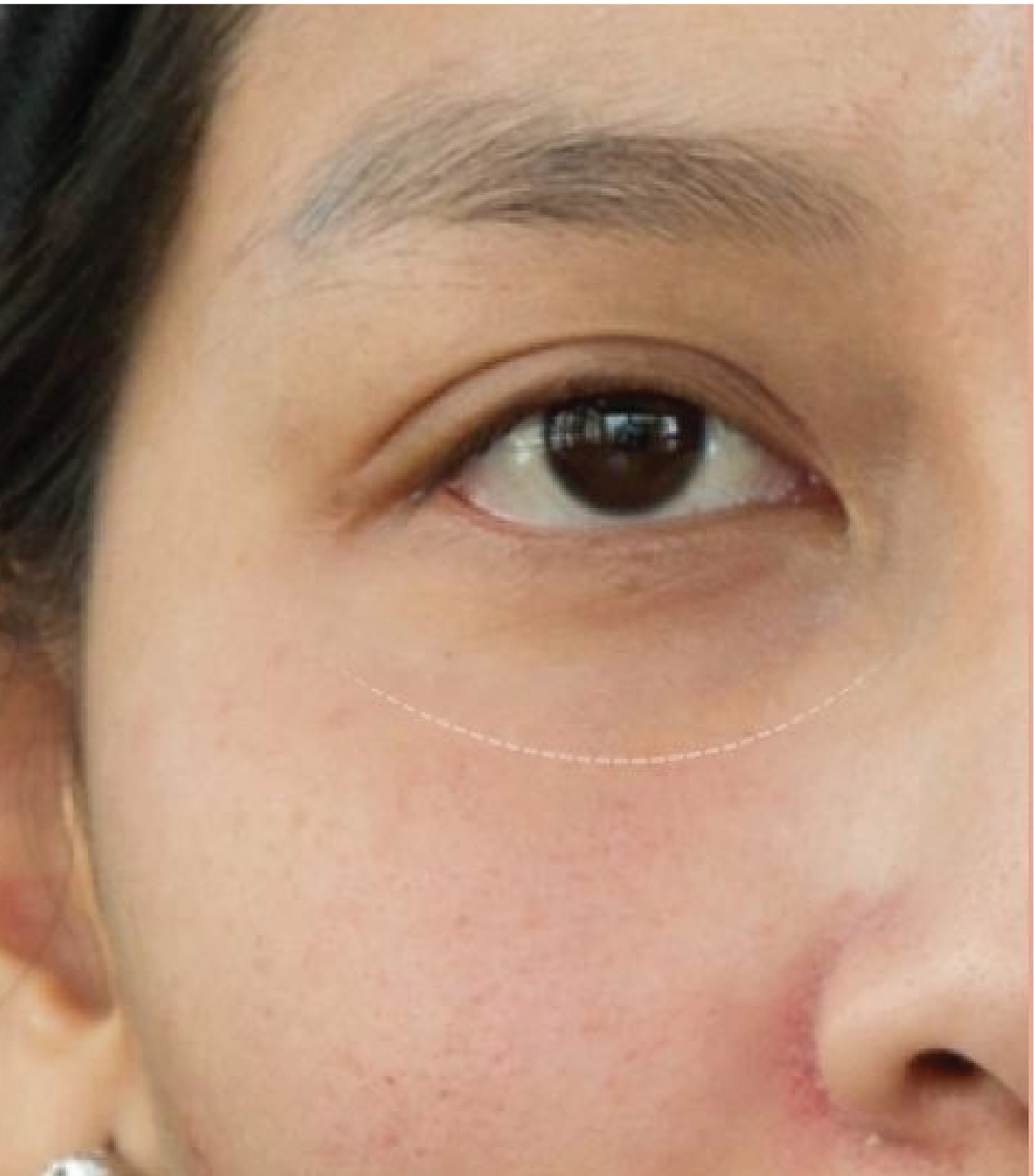 Hình ảnh trước và sau tiêm Meso Rejuran Eye