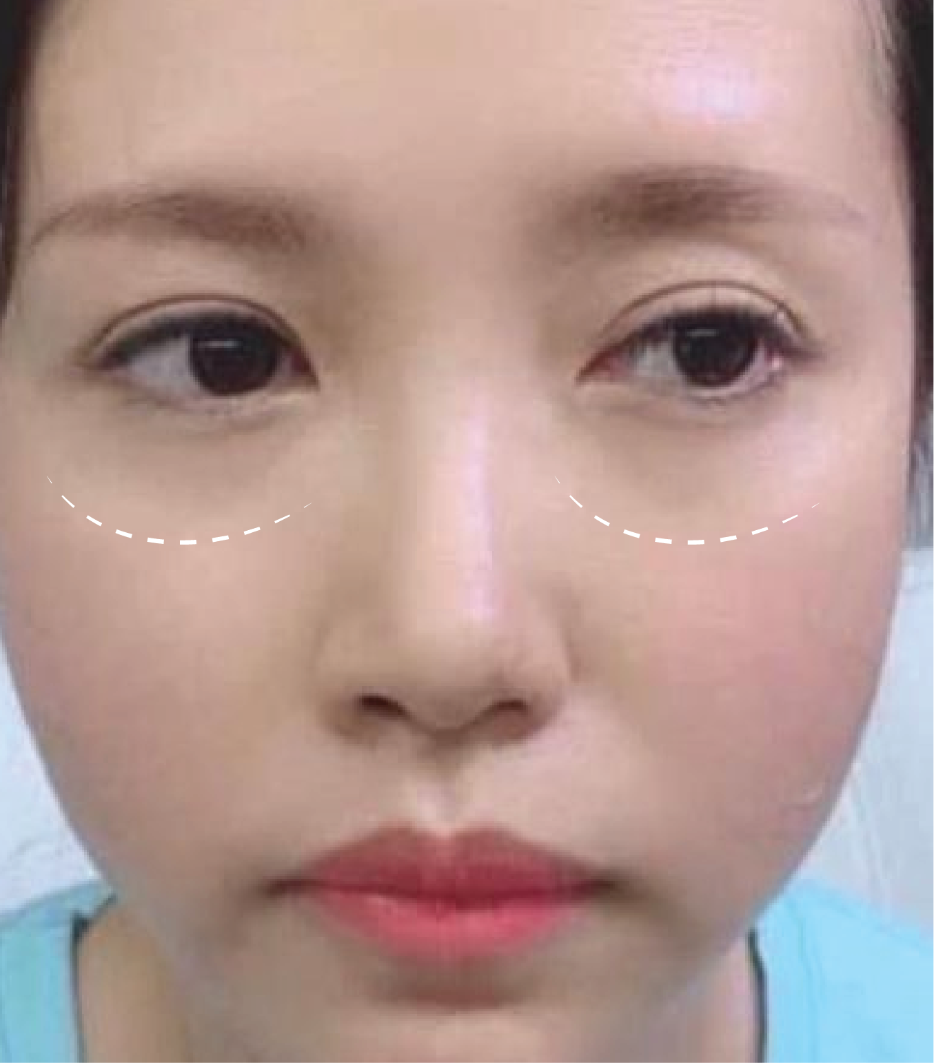 Hình ảnh trước và sau tiêm Meso Rejuran Eye
