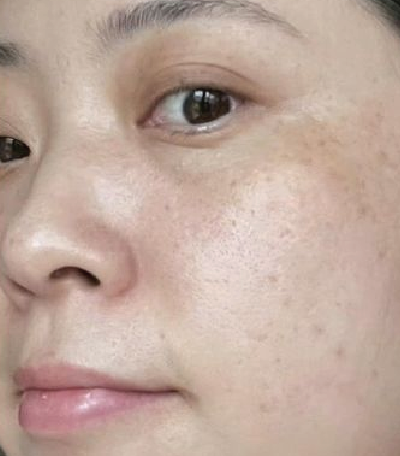 hình ảnh trước & sau khi thực hiện IPL