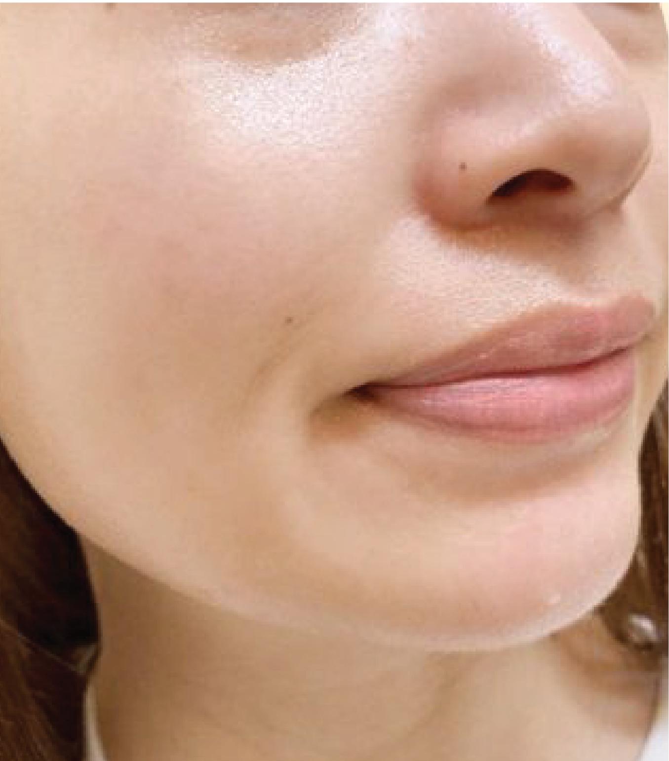 hình ảnh trước & sau khi thực hiện IPL