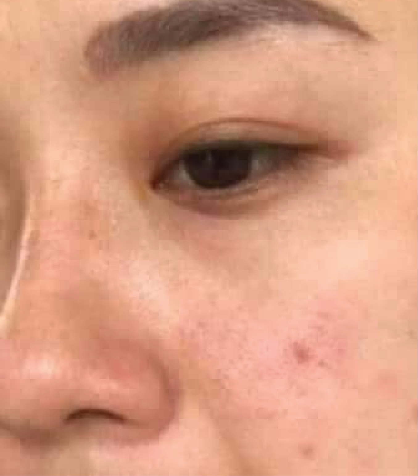 hình ảnh trước & sau khi thực hiện IPL