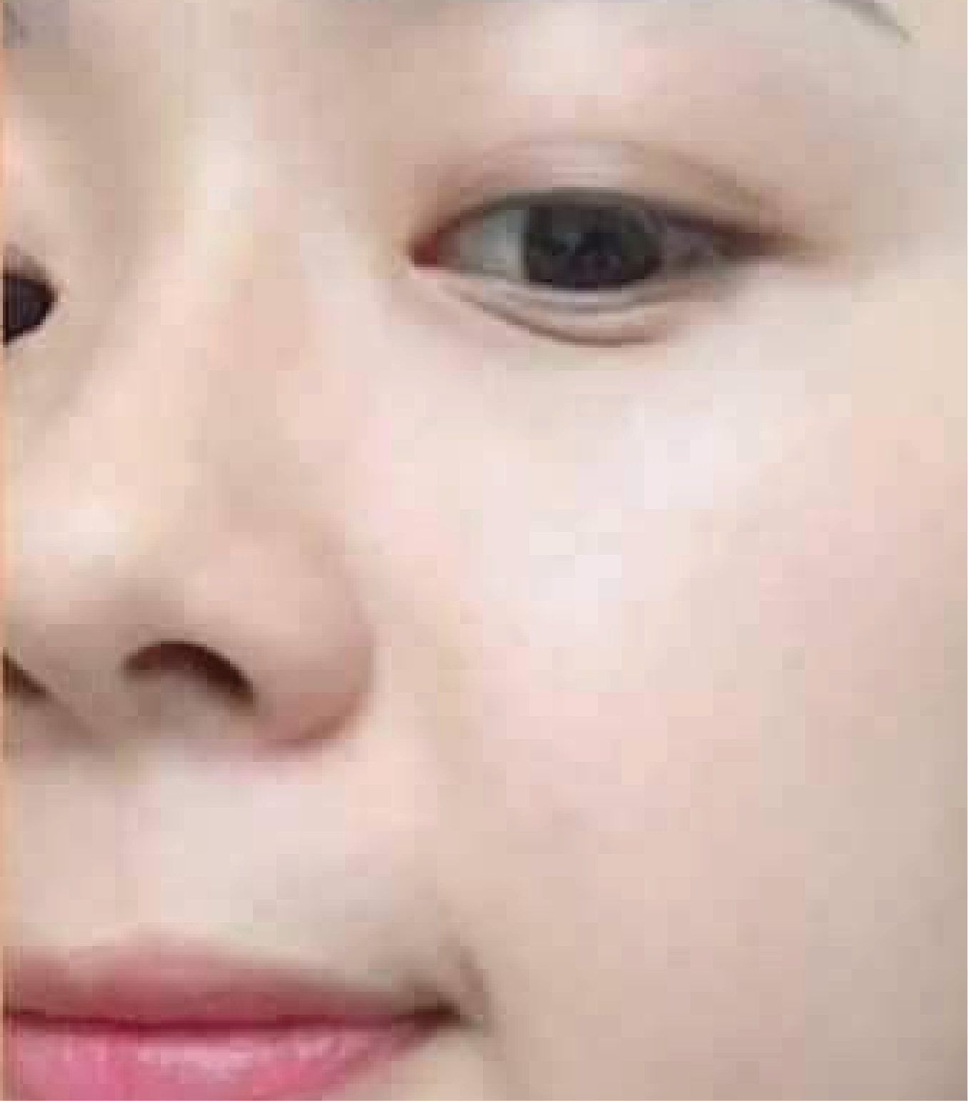 hình ảnh trước & sau khi thực hiện IPL