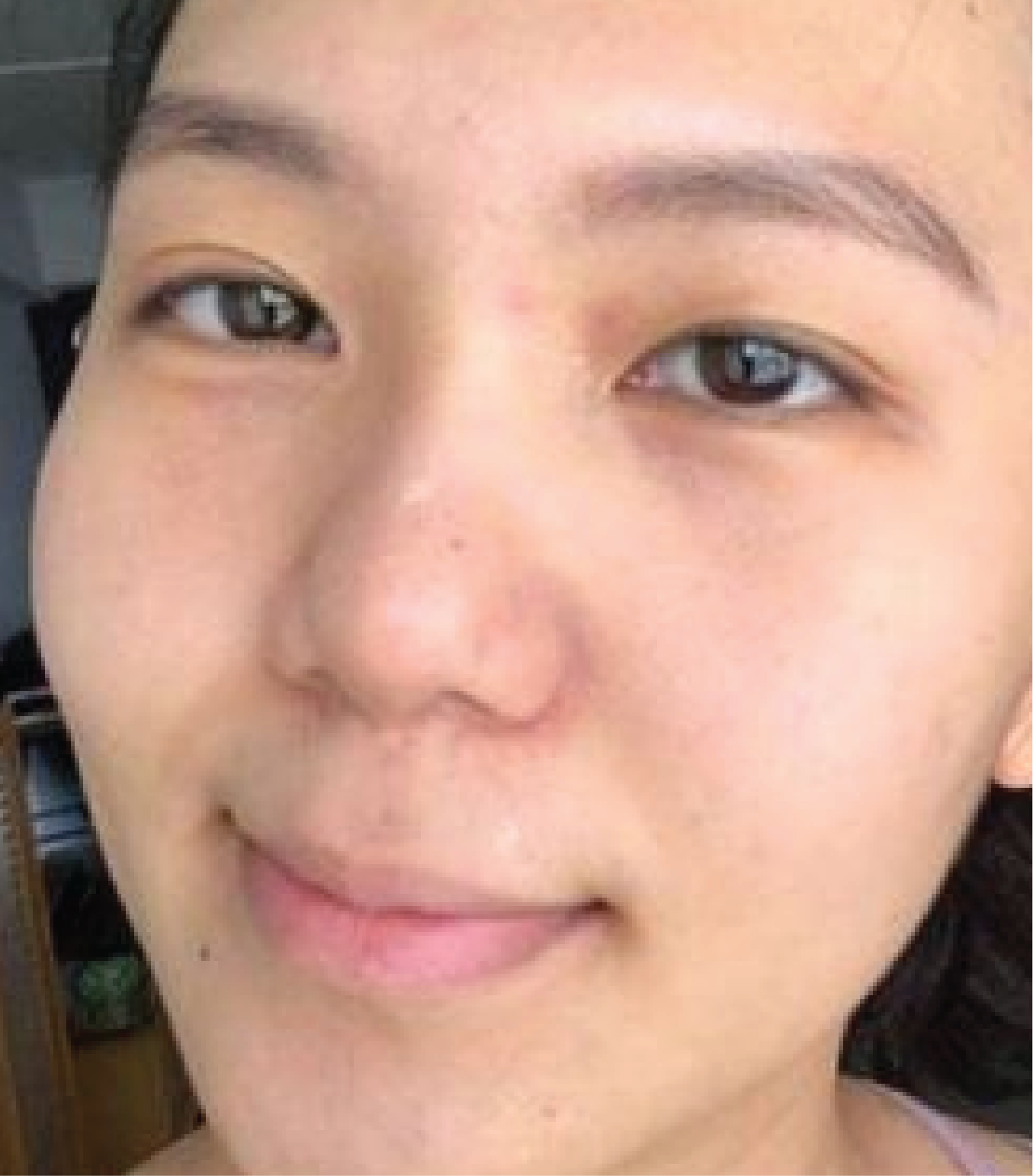 hình ảnh trước & sau khi thực hiện IPL